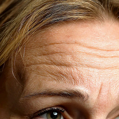 Forehead Lines