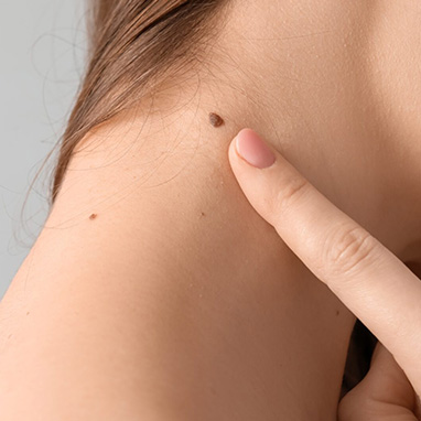 Suspicious Moles