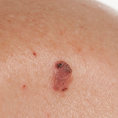 Basal and Squamous Cell Concerns