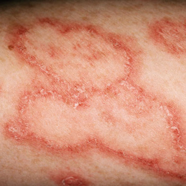 Inflammatory Conditions