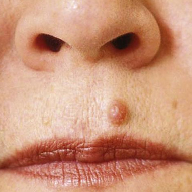 Benign Lesions