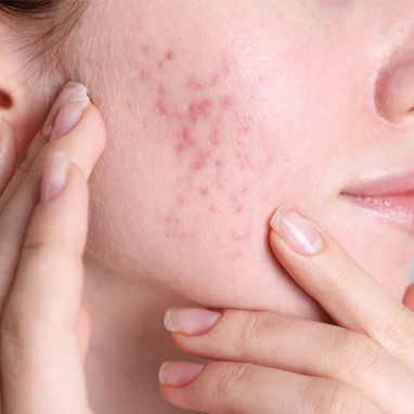 Acne Scarring