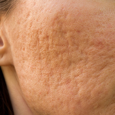 Enlarged Pores