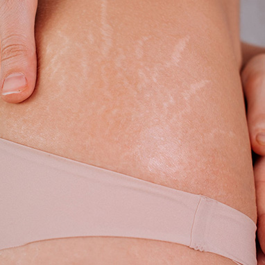 Stretch Marks