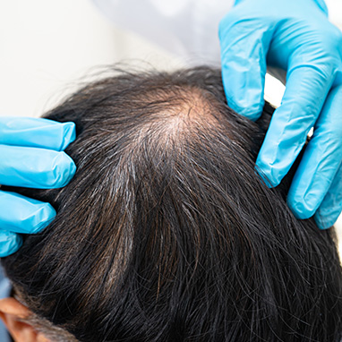 Androgenetic Alopecia