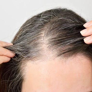 Telogen Effluvium