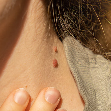 Skin Tags