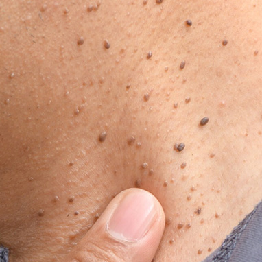Seborrheic Keratoses