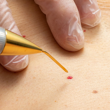 Warts & Cherry Angiomas