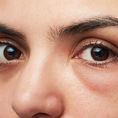 Skin Thinning