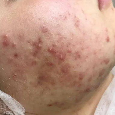 Blackheads and Comedones