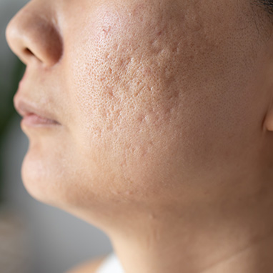 Acne Scarring (Pigmented)