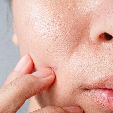 Enlarged Pores