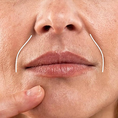 Nasolabial Folds
